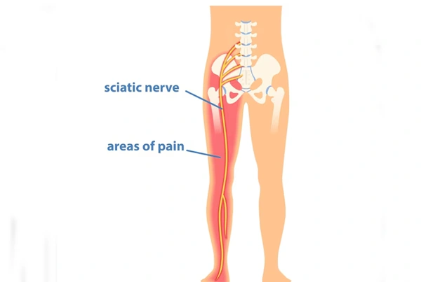 Sciatica