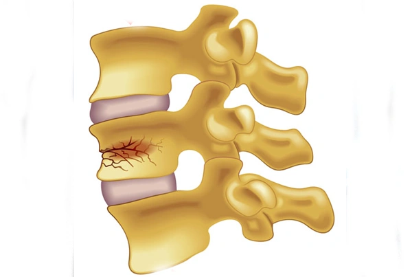 Spine and Back Pain