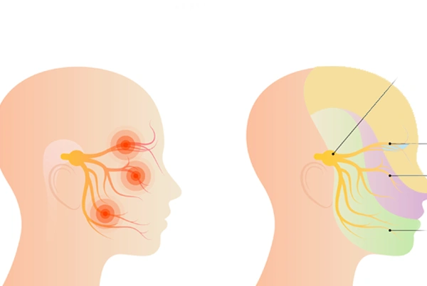 Trigeminal Neuralgia