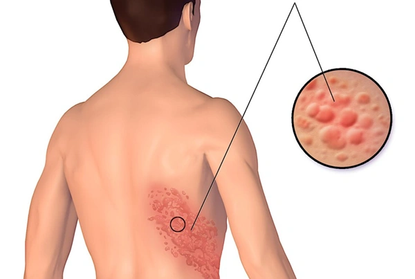Post Herpetic Neuralgia After Shingles