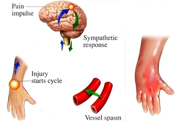 CRPS Treatment