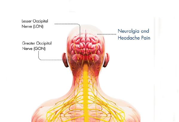 Occipital Neuralgia