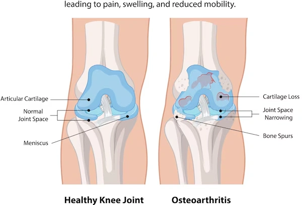 Knee Osteoarthritis