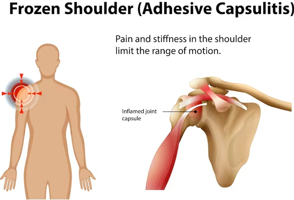 Shoulder Pain