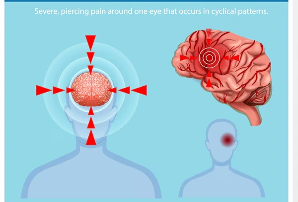 Cluster Headache