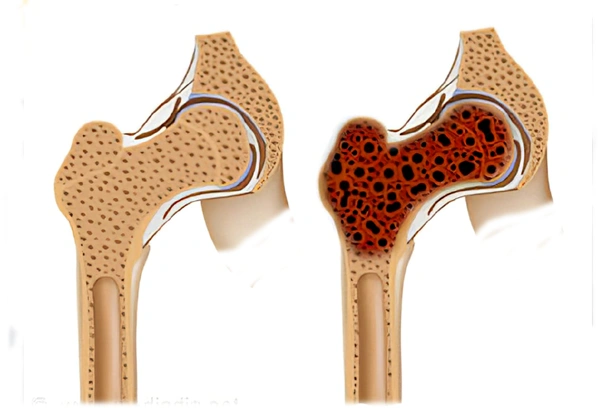 Cancer Related Bone Pain