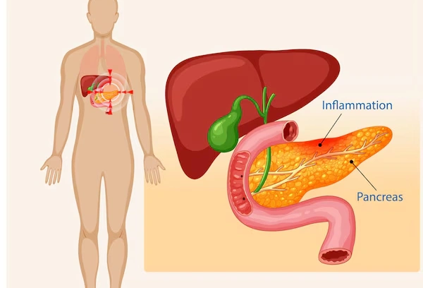 Pancreatic Pain Chronic Pancreatitis